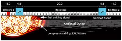 Decreased Compressional Sound Velocity Is an Indicator for Compromised Bone Stiffness in X-Linked Hypophosphatemic Rickets (XLH)